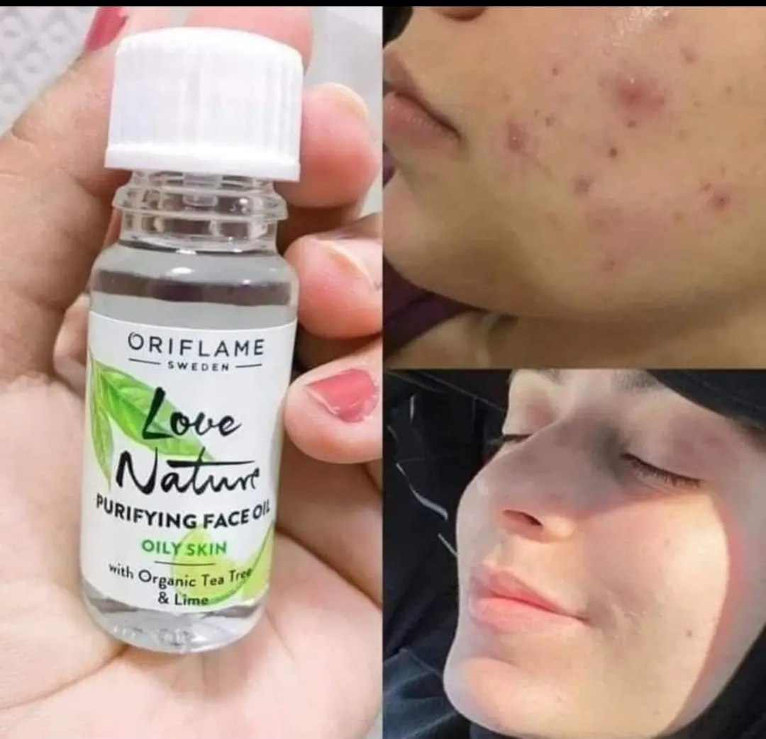روغن ضد جوش تی تری درخت چای و لیمو لاونیچر اوریفلیم اورجینال